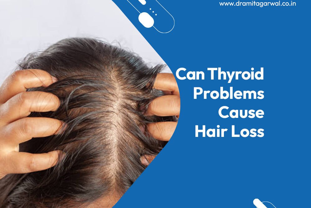 Can Thyroid Problems Cause Hair Loss