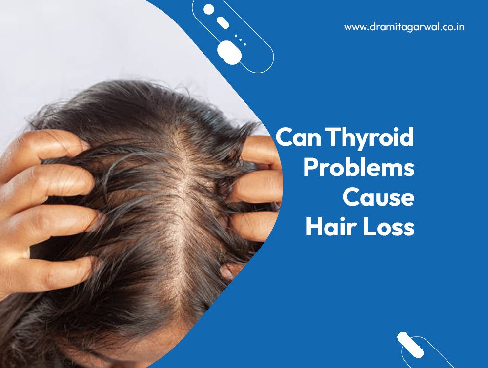 Can Thyroid Problems Cause Hair Loss?