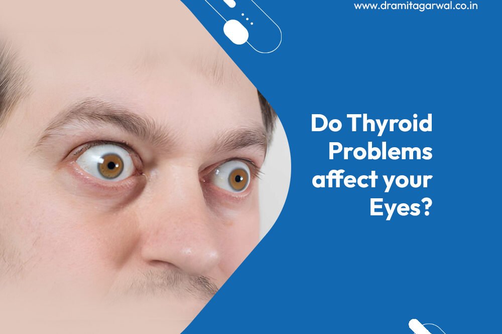 Do Thyroid Problems Affect Your Eyes