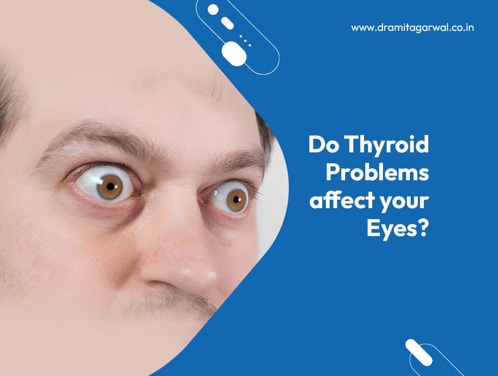 Do Thyroid Problems Affect Your Eyes?