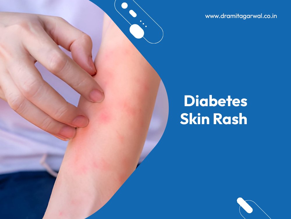 Diabetes Skin Rash