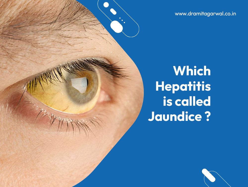 Which Hepatitis is Called Jaundice
